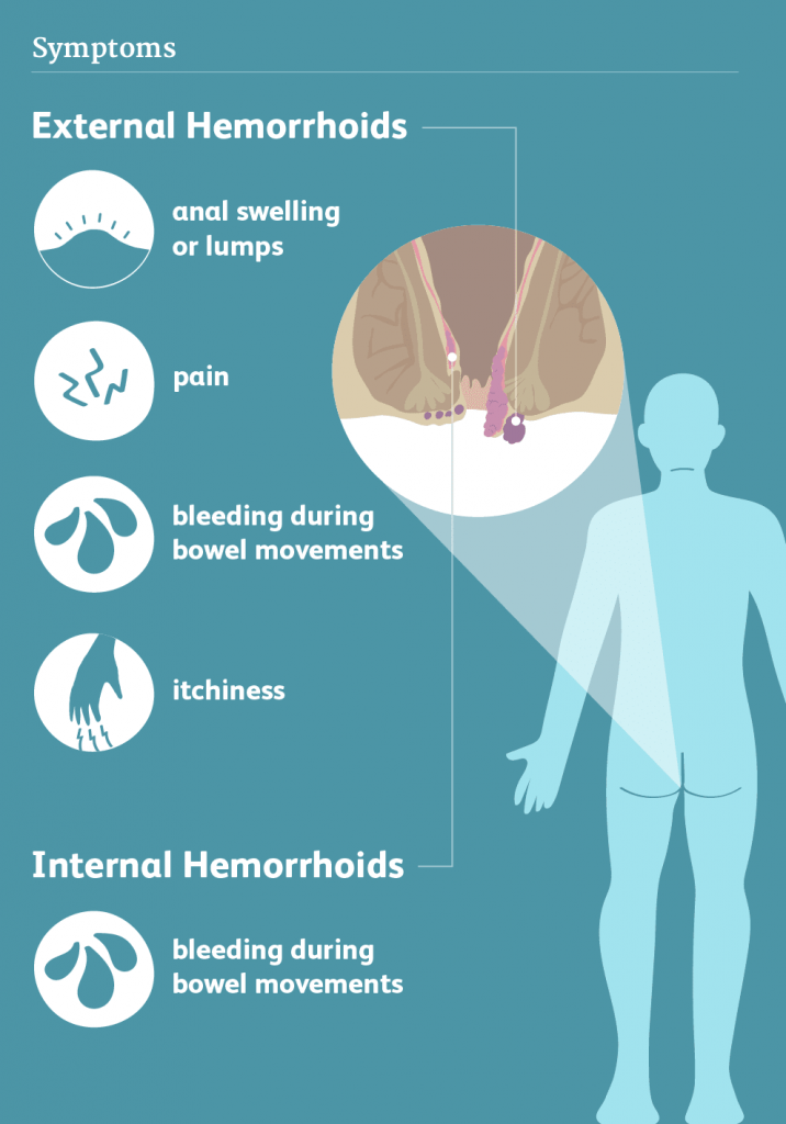 hemorrhoids symptoms 3