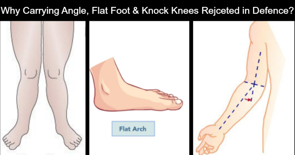 Are Carrying Angle Flat Foot and Knock Knees Allowed in Defence