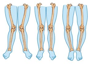 How to Check Knock Knees for Indian Army SSB?