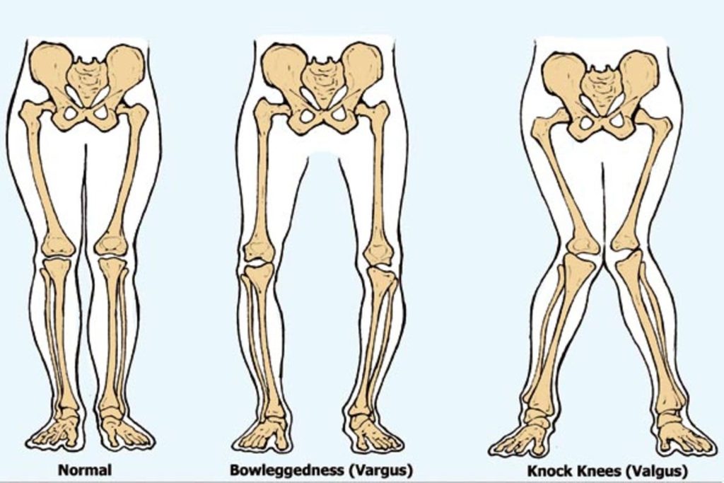 How to Check Knock Knees for Indian Army SSB?